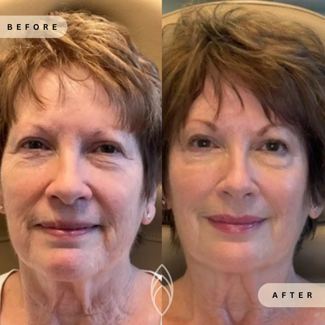 Facial Balancing Skin Health Before and After Results - Renu Aesthetics in Grants Pass, OR
