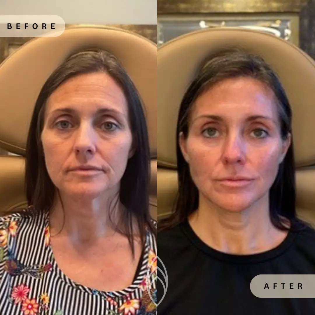 Facial Balancing Skin Health Before and After Results - Renu Aesthetics in Grants Pass, OR
