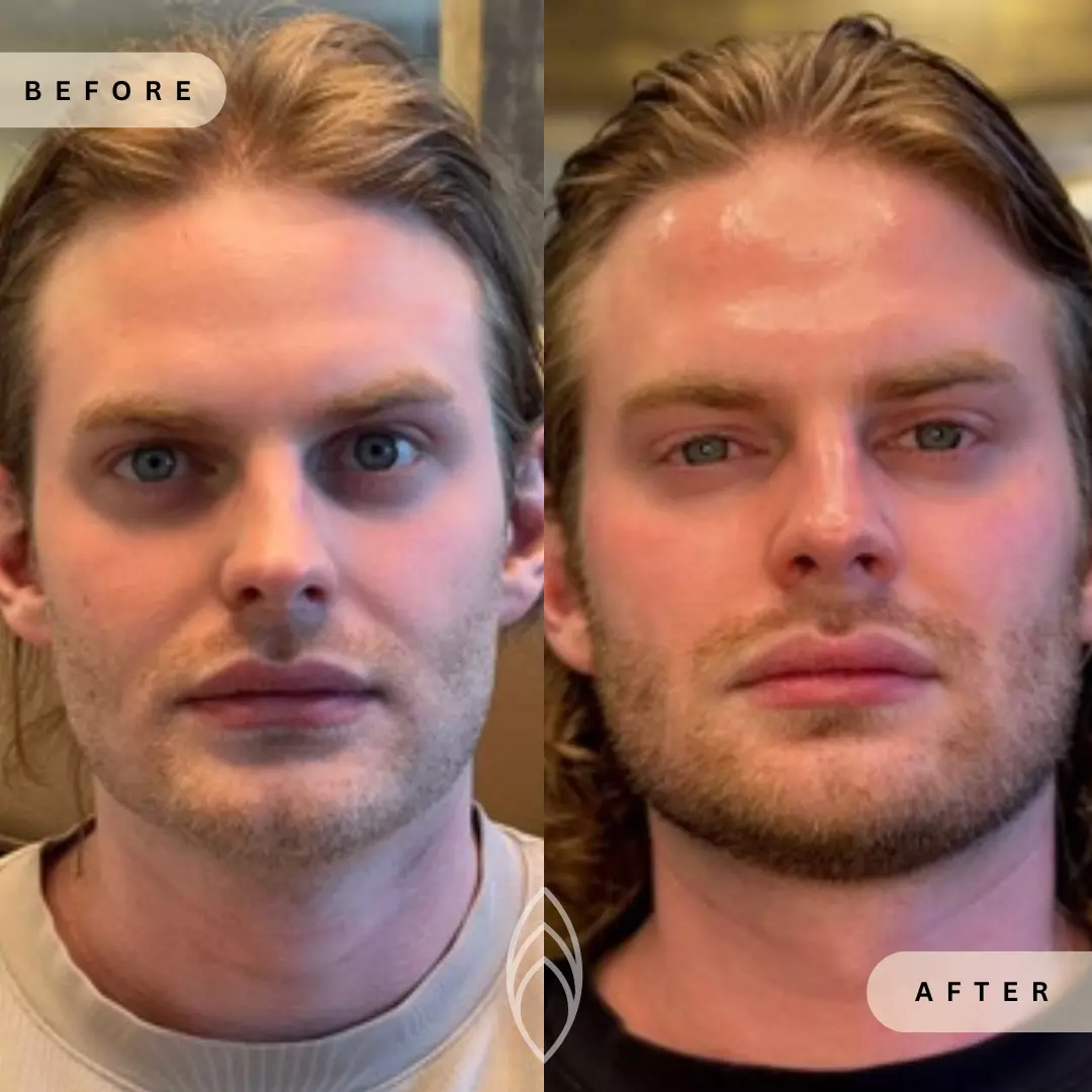 Facial Balancing Skin Health Before and After Results - Renu Aesthetics in Grants Pass, OR