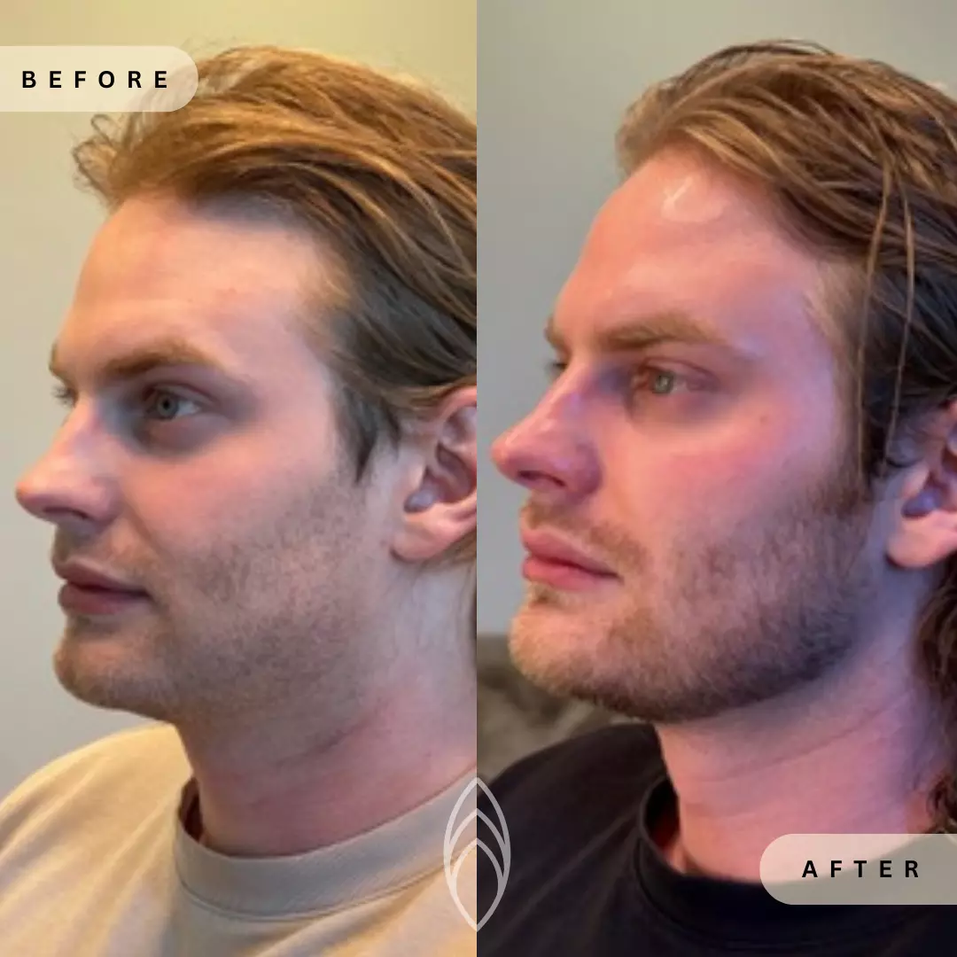 Facial Balancing Skin Health Before and After Results - Renu Aesthetics in Grants Pass, OR