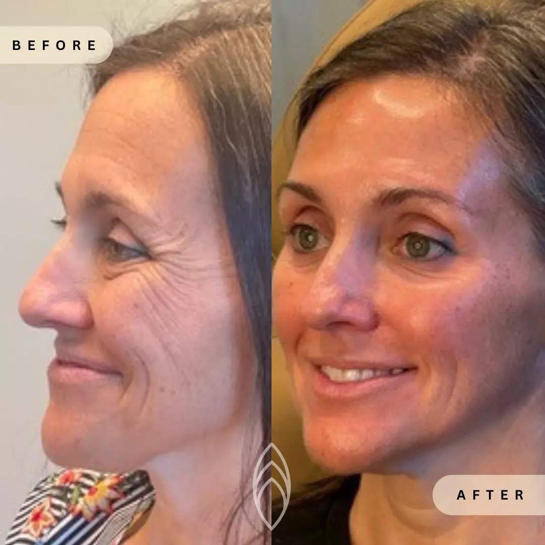 Facial Balancing Skin Health Before and After Results - Renu Aesthetics in Grants Pass, OR