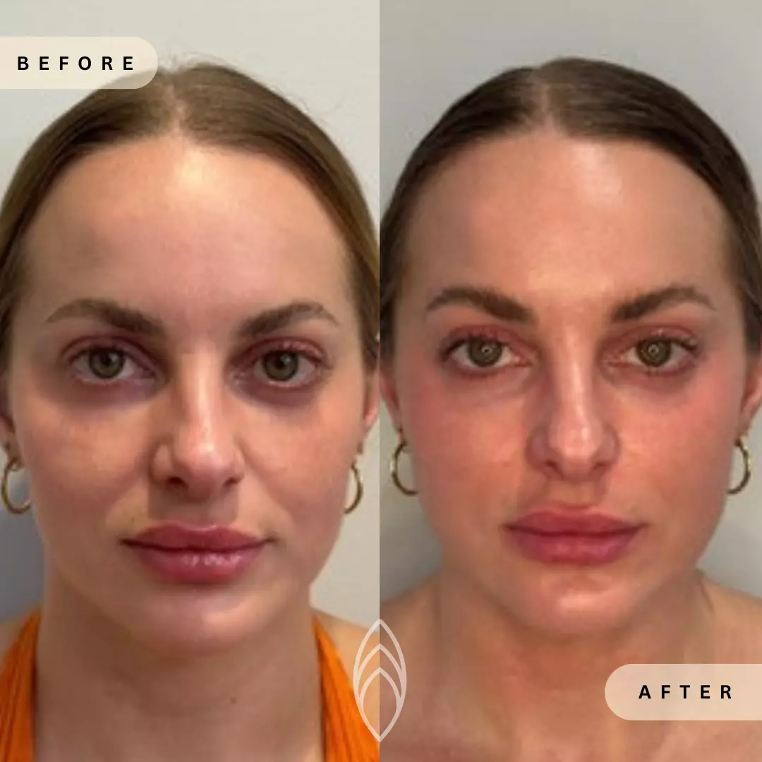 Facial Balancing Skin Health Before and After Results - Renu Aesthetics in Grants Pass, OR