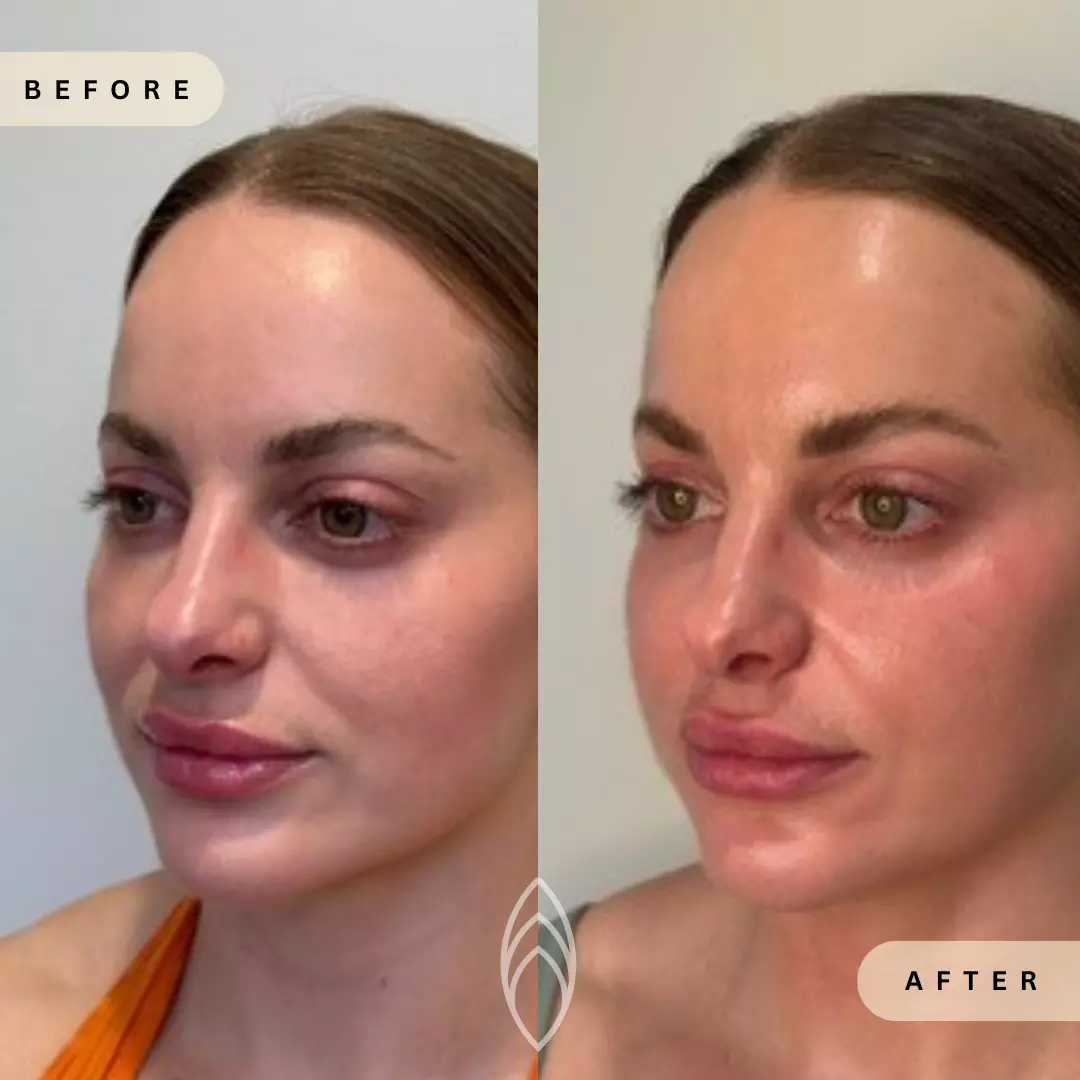 Facial Balancing Skin Health Before and After Results - Renu Aesthetics in Grants Pass, OR