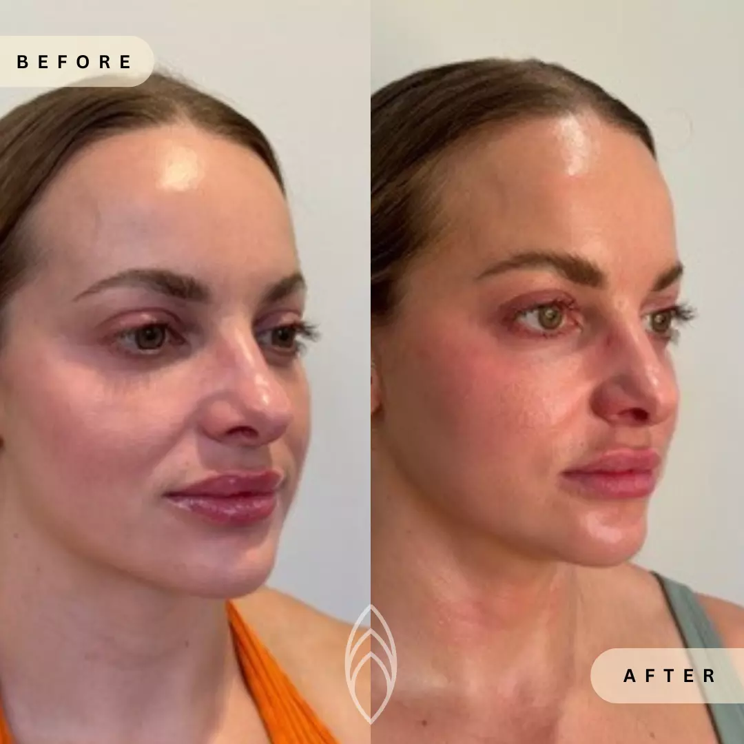 Facial Balancing Skin Health Before and After Results - Renu Aesthetics in Grants Pass, OR