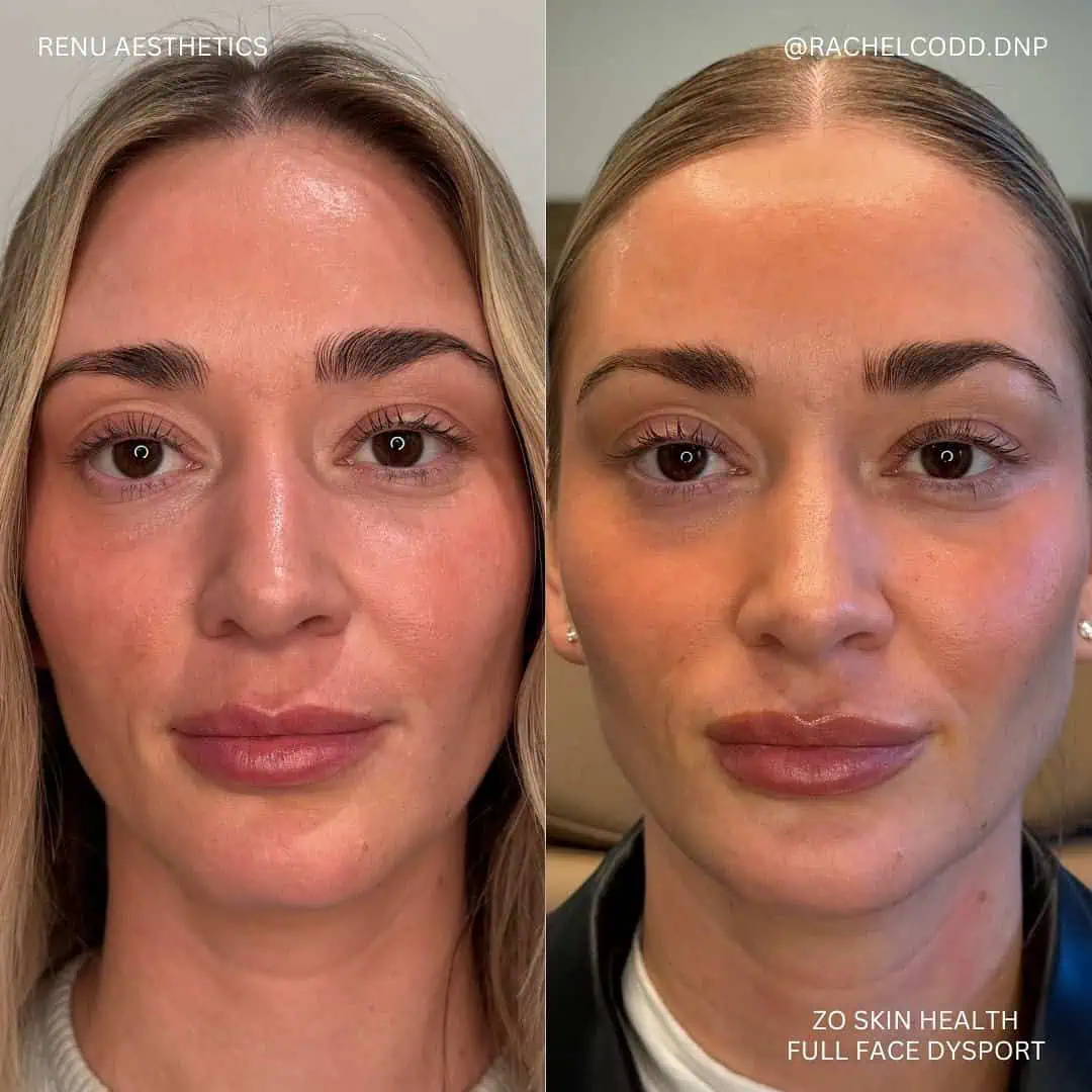 zo skin health full face dysport