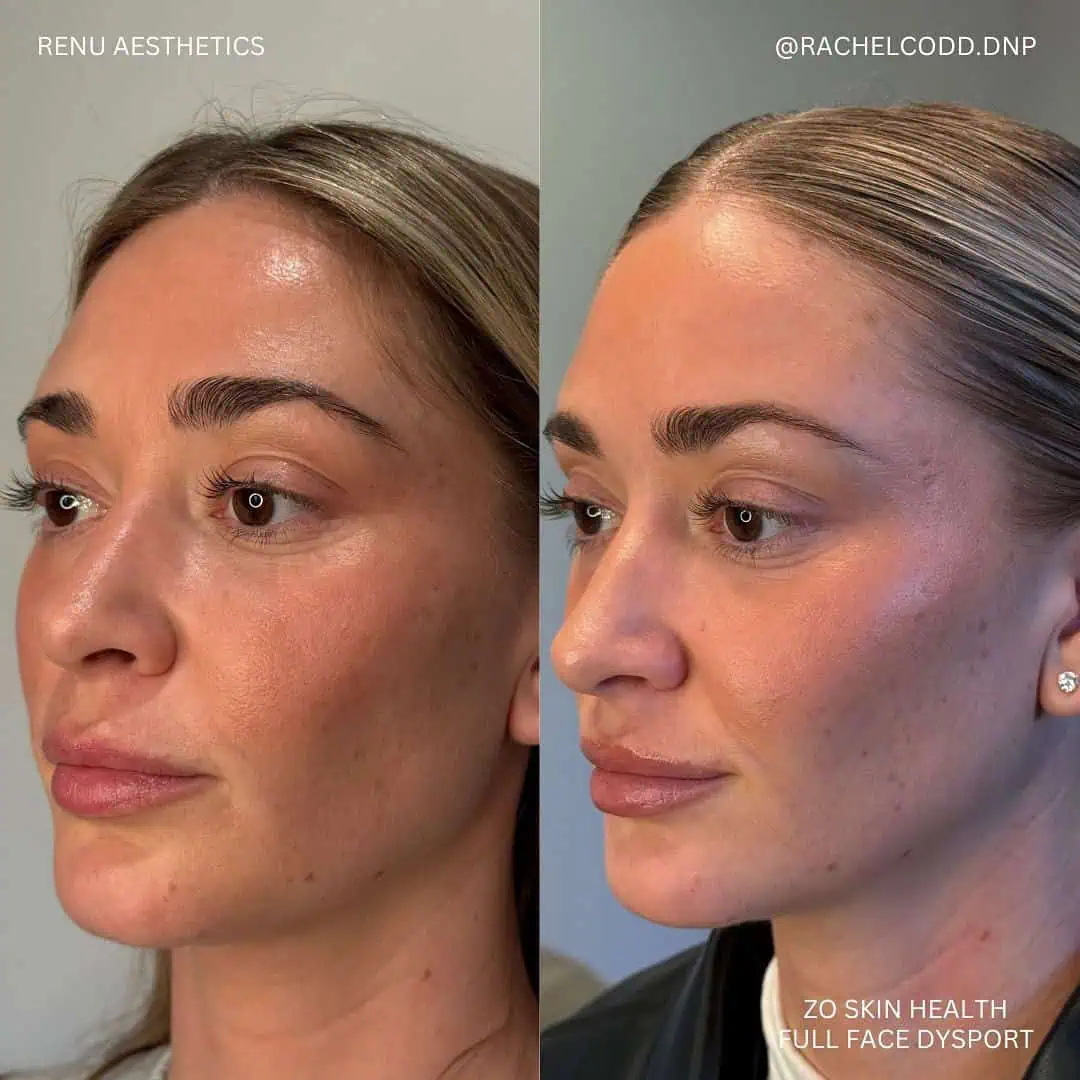 zo skin health full face dysport