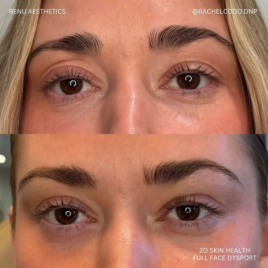 zo skin health full face dysport one