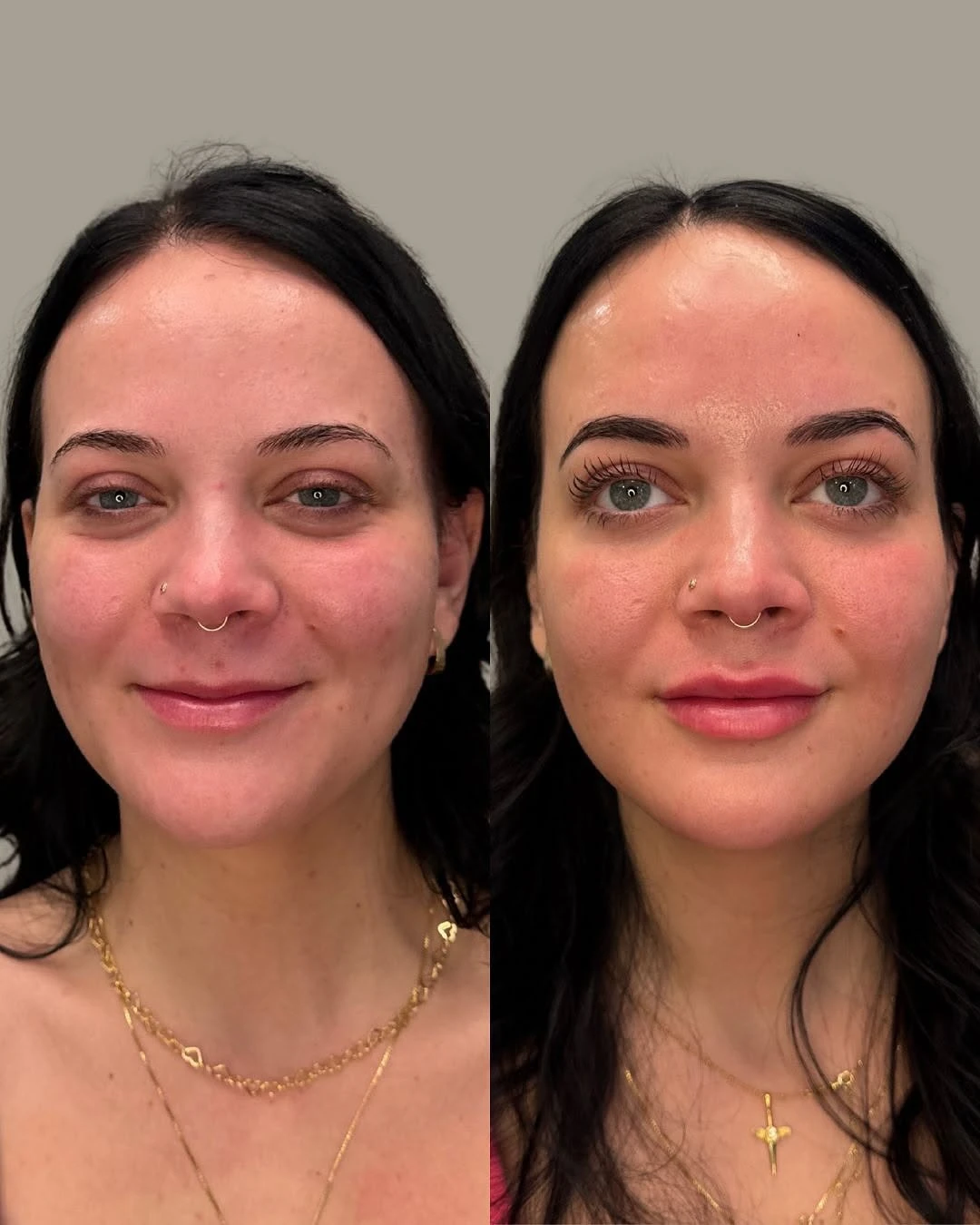 Before and After Images | Full face botox + Nefertiti neck lift in Grants Pass, OR | Renu Aesthetics