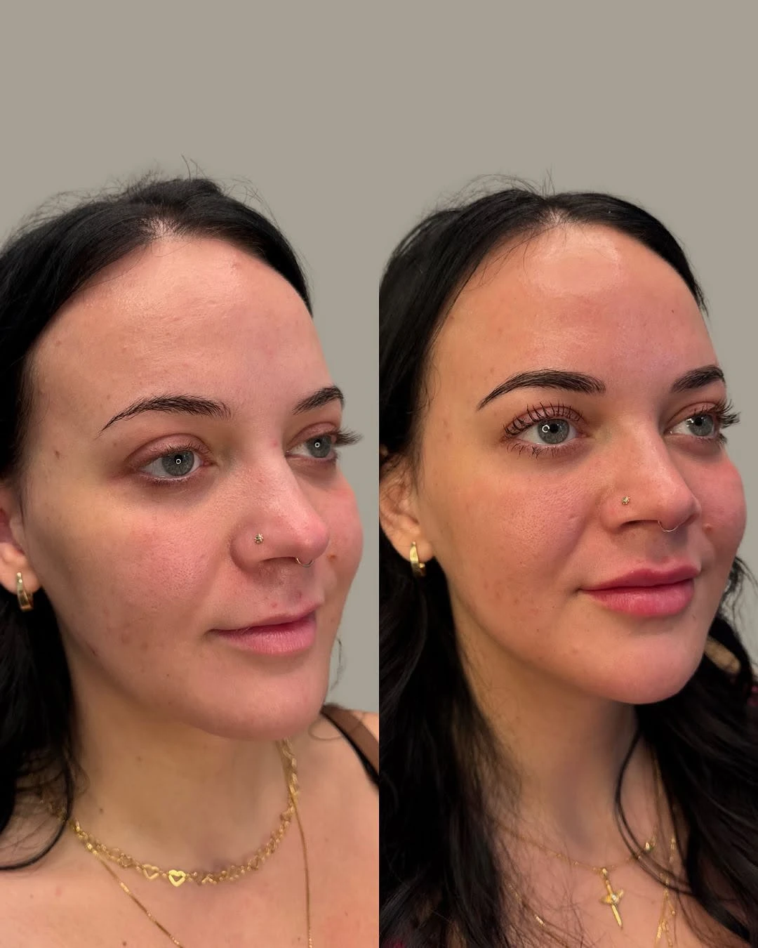 Before and After Images 2 | FACIAL BALANCING + MASSETER BOTOX + SKIN HEALTH in Grants Pass, OR | Renu Aesthetics