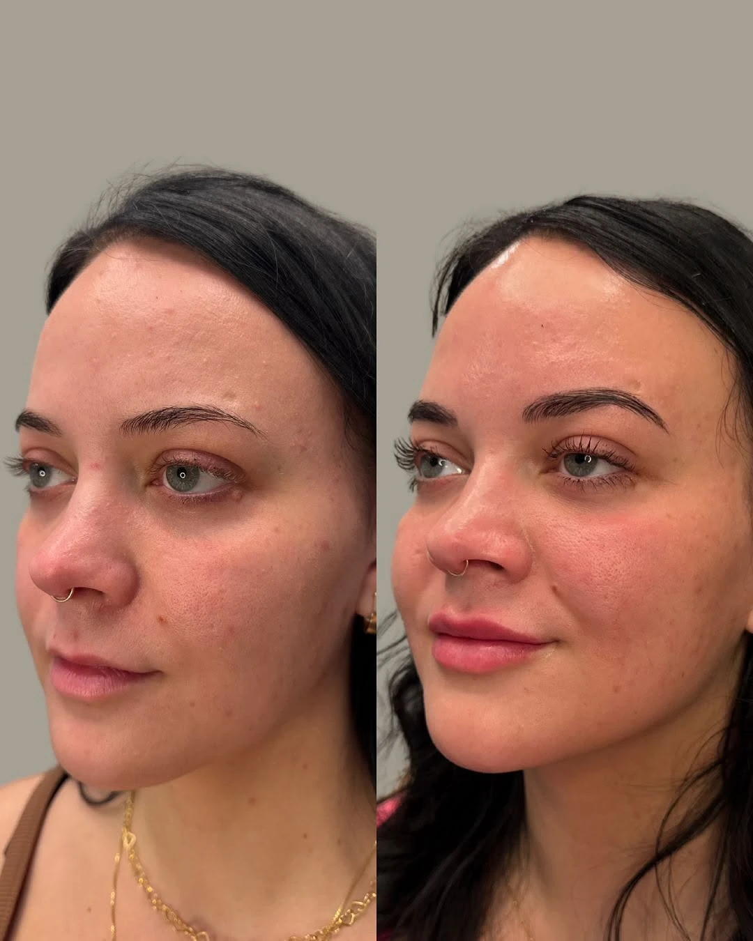 Before and After Images | FACIAL BALANCING + MASSETER BOTOX + SKIN HEALTH in Grants Pass, OR | Renu Aesthetics