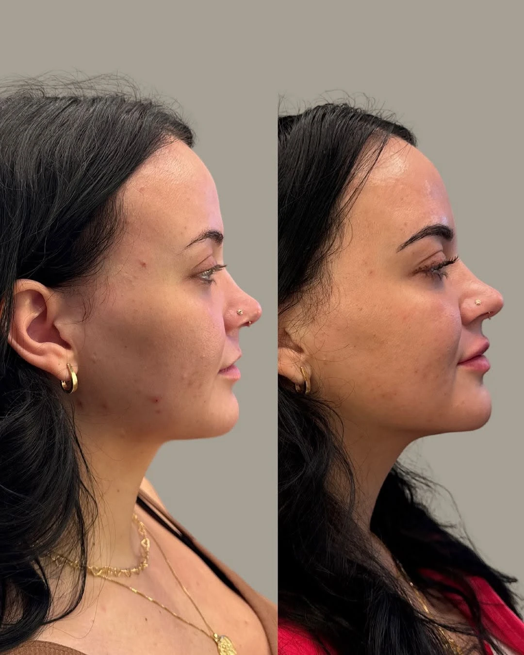 Before and After Images 2 | Full face botox + Nefertiti neck lift in Grants Pass, OR | Renu Aesthetics