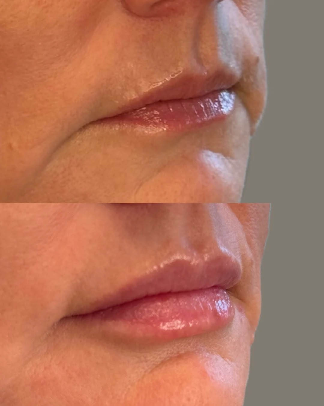 Before and After Images | Framing the Lips + Lip Volume/Shape in Grants Pass, OR | Renu Aesthetics