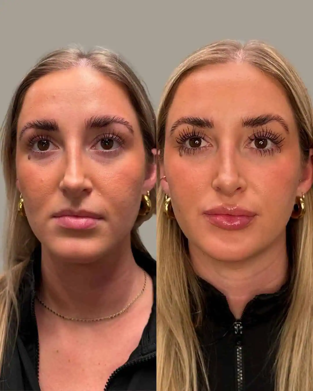 Before and After Images of Face | Facial Balancing in Grants Pass, OR | Renu Aesthetics