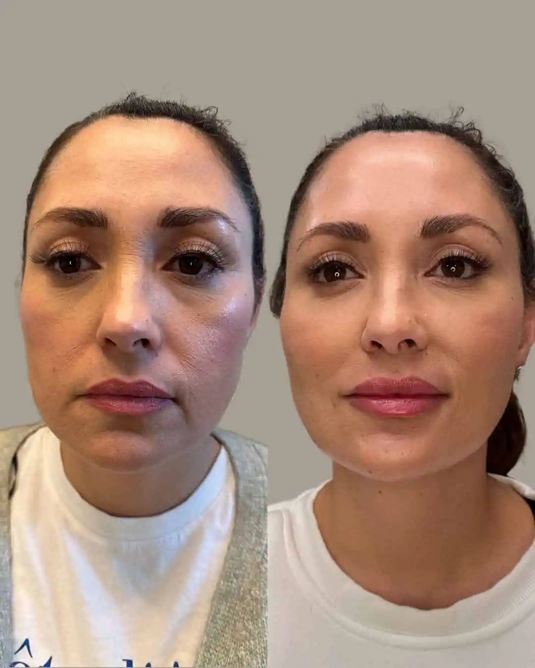 Before and After Images | Facial Balancing in Grants Pass, OR | Front Face | Renu Aesthetics