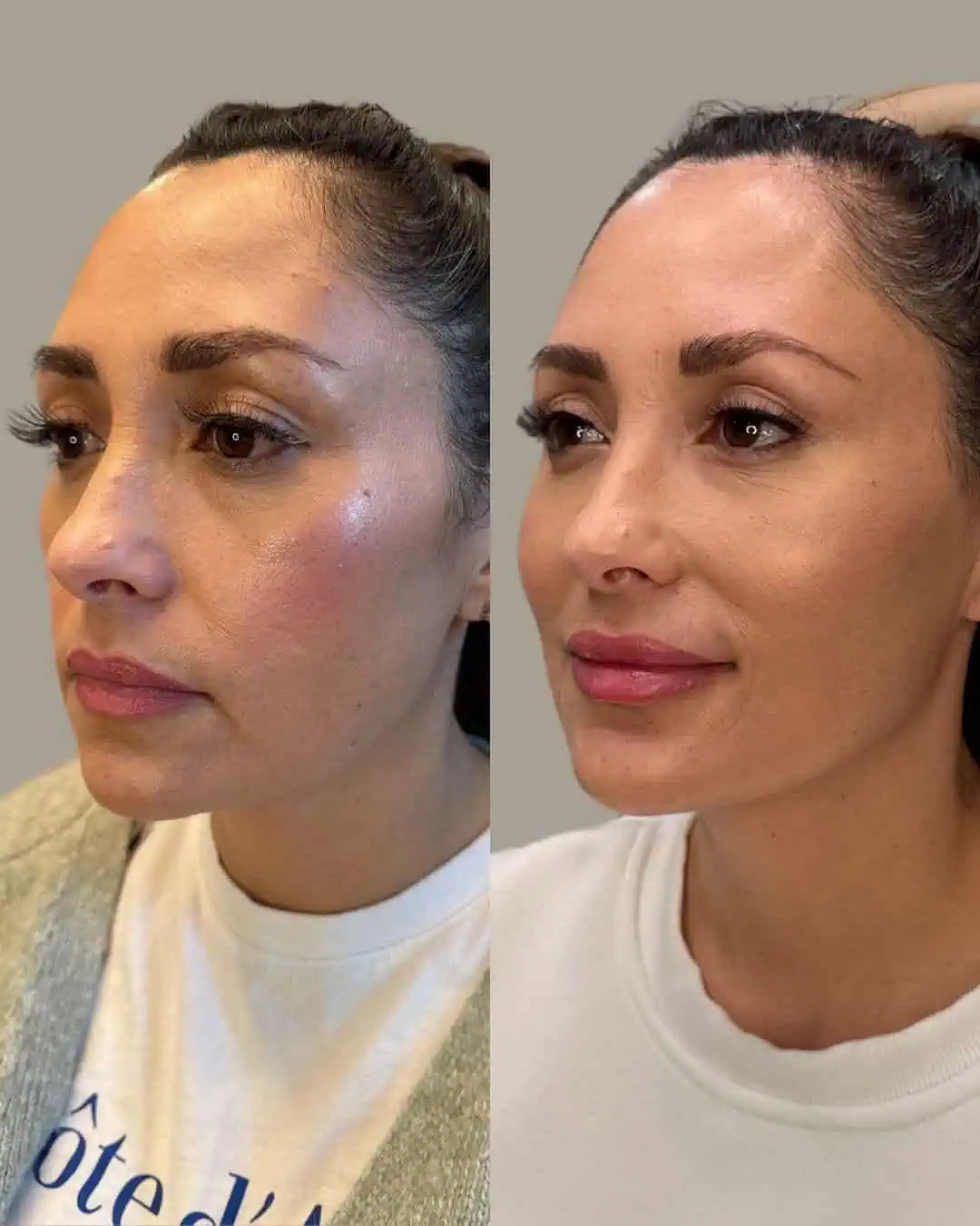 Before and After Images | Facial Balancing in Grants Pass, OR | Left Face Front | Renu Aesthetics