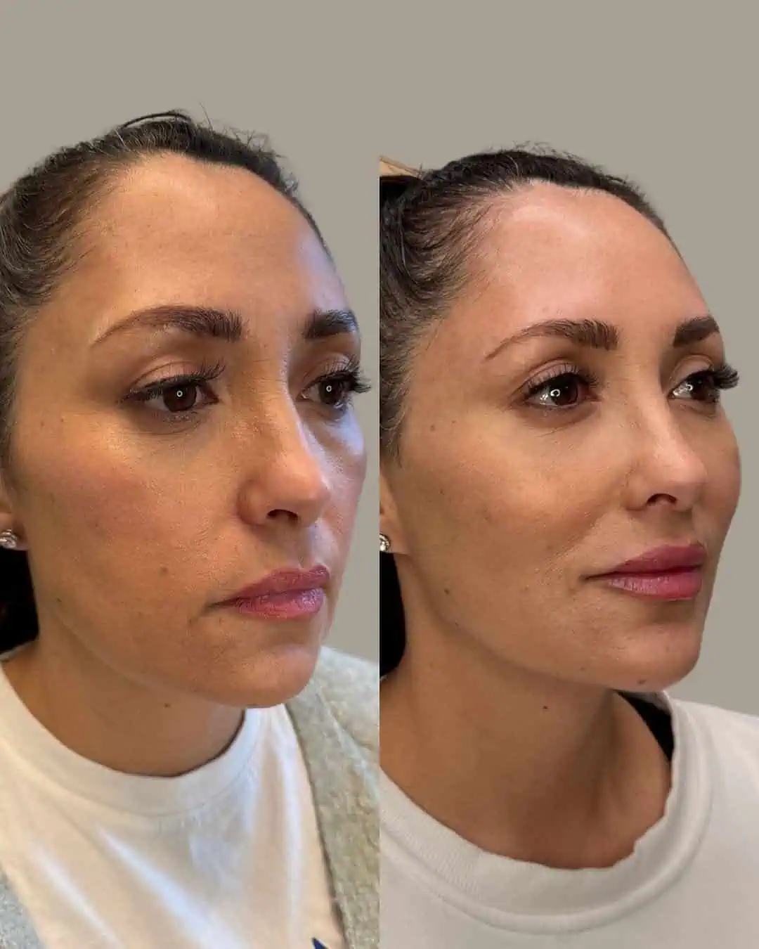 Before and After Images | Facial Balancing in Grants Pass, OR | Right Face | Renu Aesthetics