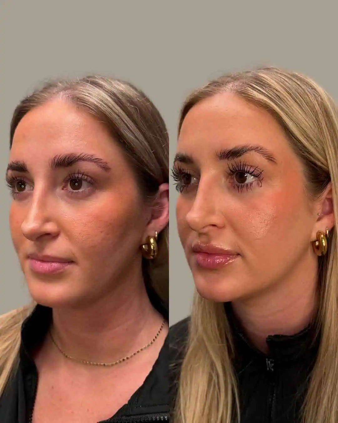 Before and After Images | Facial Balancing in Grants Pass, OR | Left Side Face | Renu Aesthetics