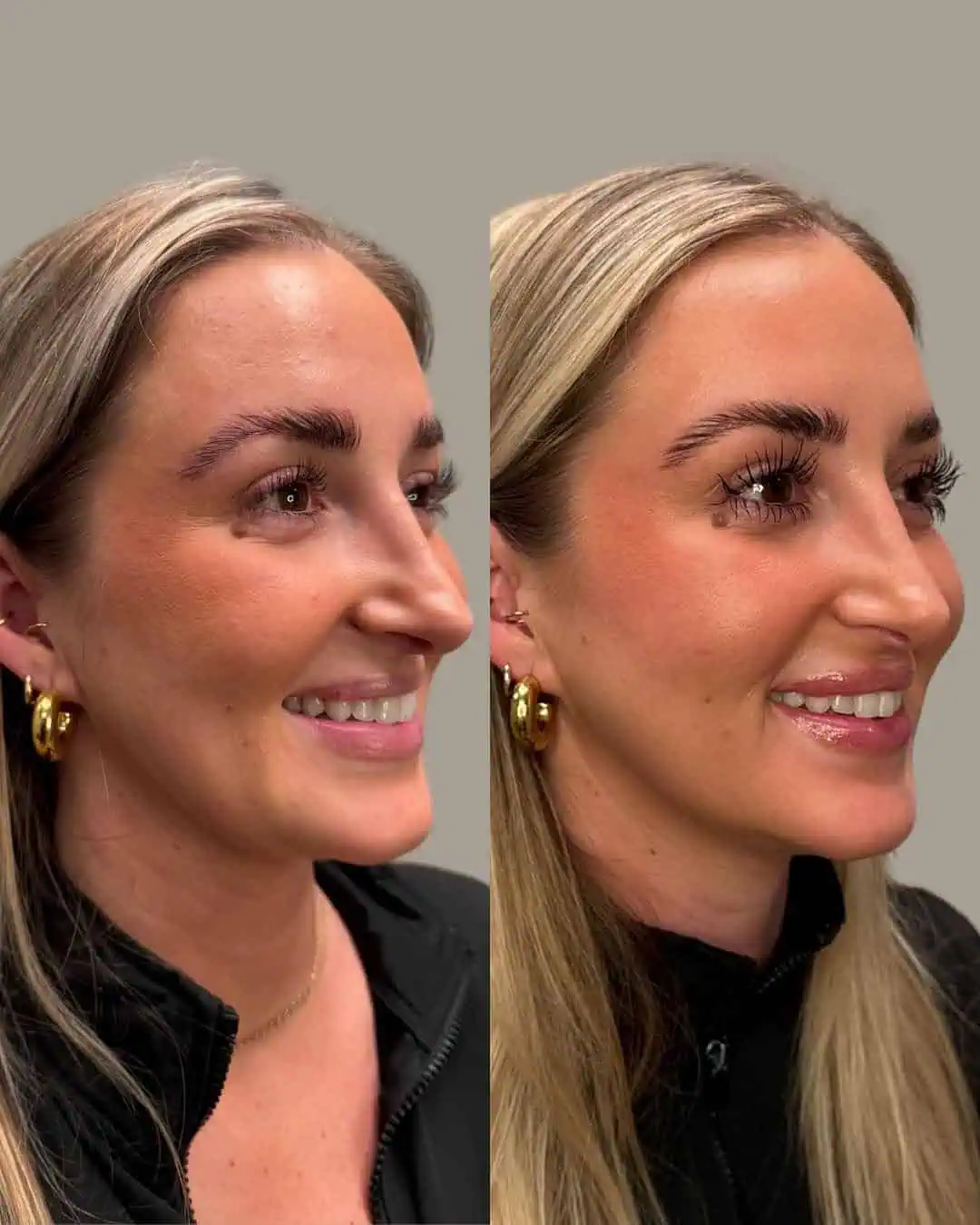 Before and After Images | Facial Balancing in Grants Pass, OR | Right Side Face | Renu Aesthetics