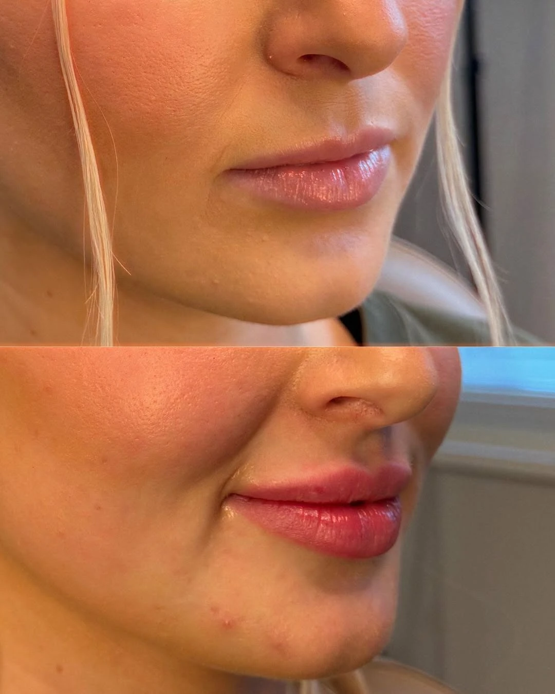 Before and After Images 2 | Soft Feminine Lips Using Botox Lip Flip and HA Fillers in Grants Pass, OR | Renu Aesthetics