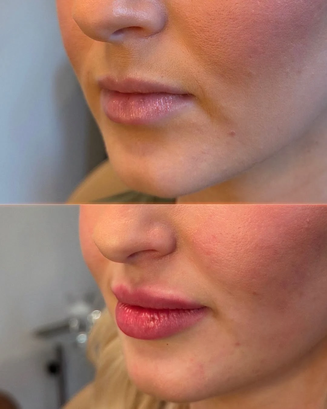 Before and After Images | Soft Feminine Lips Using Botox Lip Flip and HA Fillers in Grants Pass, OR | Renu Aesthetics